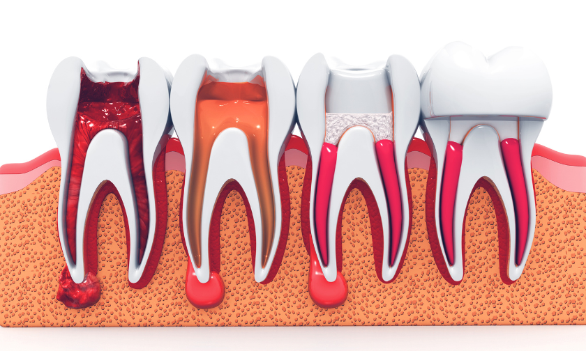 Pain Management During and After a Root Canal